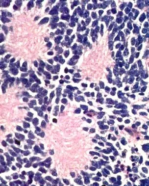 neuroblastoma iLive egészségéért