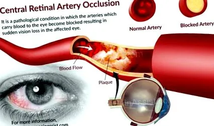 retina eye-health