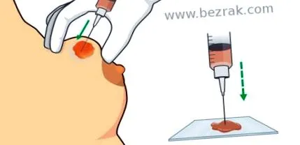 rektómia biopszia