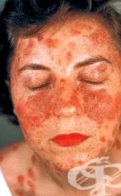 pemphigus pemphigus