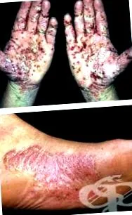 palmoplantar