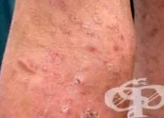 Pityriasis lichenoides chronica lichenoides chronica