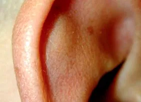 othematoma othematoma