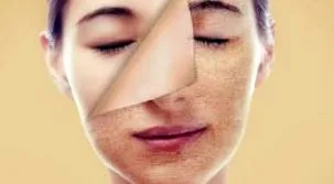 peeling univerzális