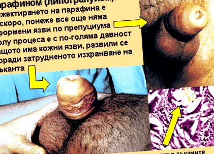 pénisz idegen anyagok
