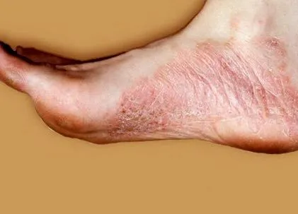 palmoplantar pustulosis lézeres eltávolítása