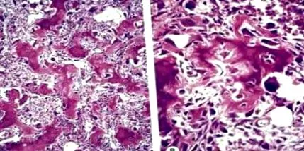 osteoma frontális sinus