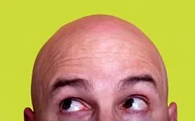 androgén alopecia androgén alopecia