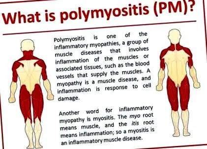 okok polymyositis