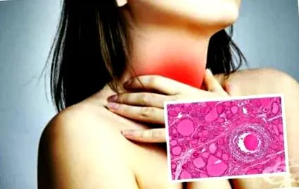 szubakut thyreoiditis