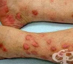prurigo nodularis nodularis