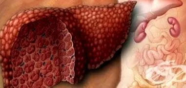 biliaris cirrhosis biliaris cirrhosis