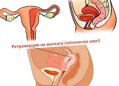 uteri méhen belüli