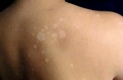 pityriasis túlzott izzadás