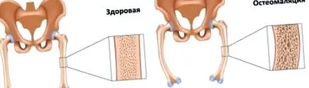 osteomalacia csont