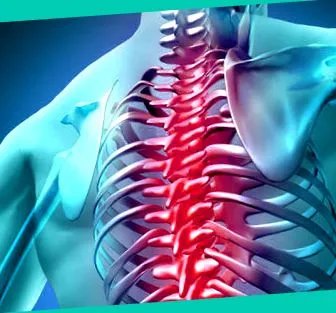 spondylitis