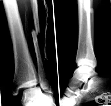 fibula fibula