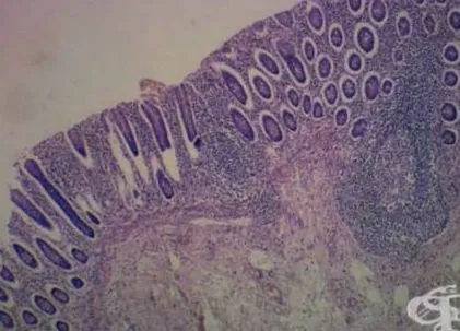 enteritis enteritis