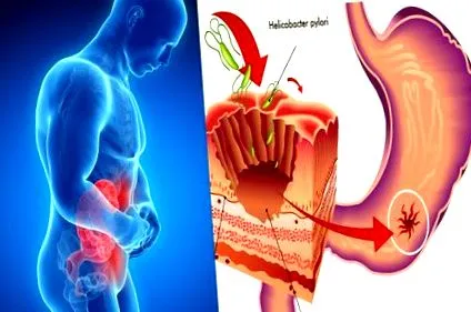 Helicobacter pylori helicobacter
