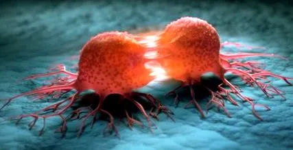 teratoma sacrococcygeal