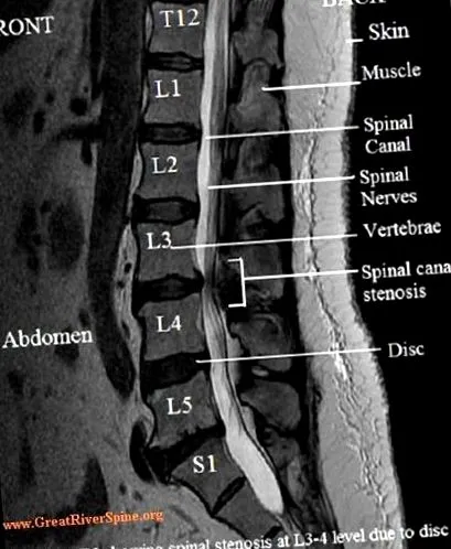 spinal stenosis