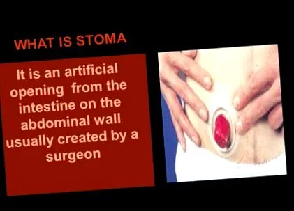 stoma