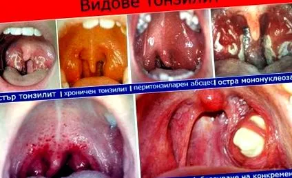 tonsillitis tonsillitis