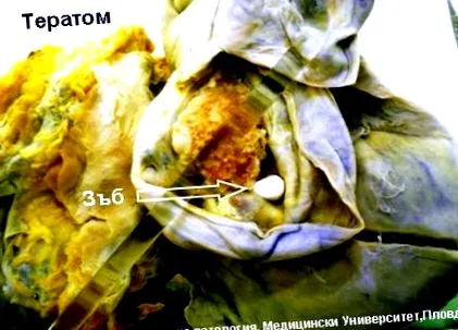 teratoma teratoma