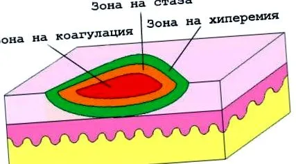 égések