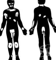hogy vitiligo