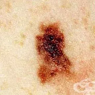 melanoma