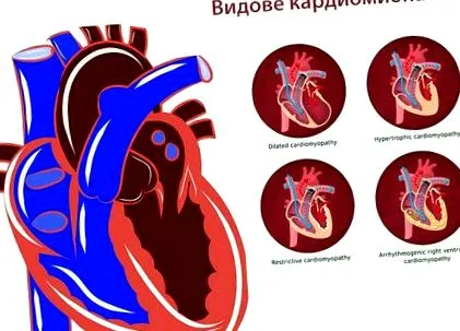 típusai kardiomiopátiák