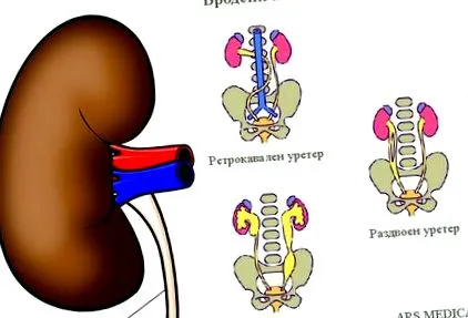 vesicoureteralis reflux