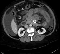 abdominală