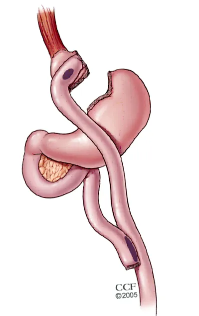 intestinului subțire