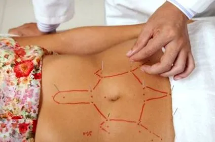 acupunctura