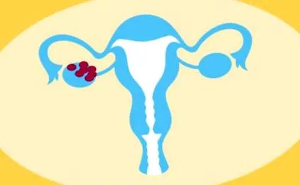 pcos
