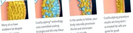 skinney coolsculpting