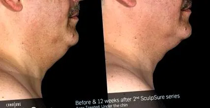 sculpsure