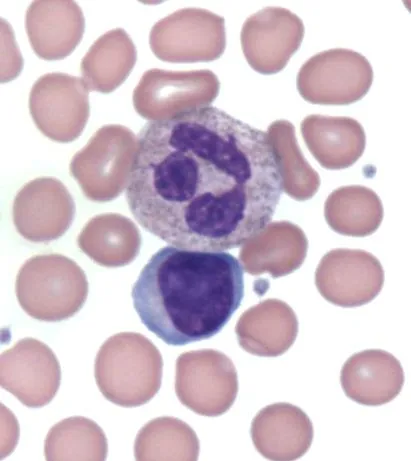 cancerului