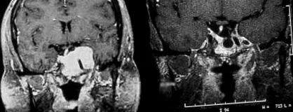 prolactinom