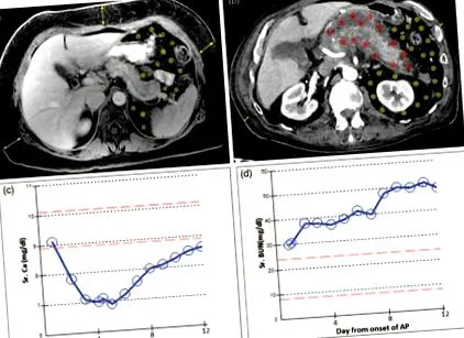 pancreatitei acute