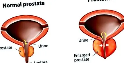 prostatitei
