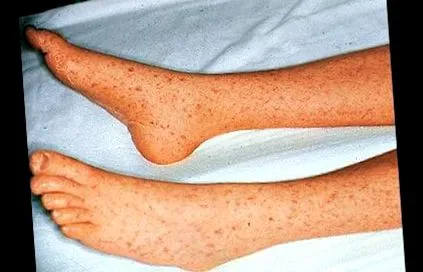 ricină