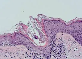 demodex dermnet