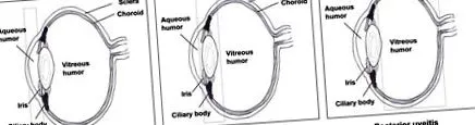 uveitis