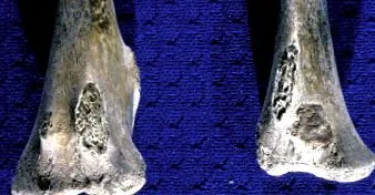 exostosis
