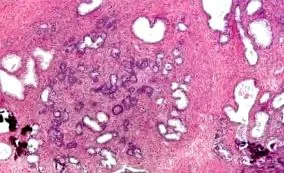 hyperplasia típusok