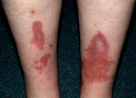 necrobiosis
