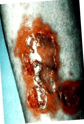 lipoidica